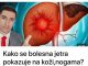 Kako se bolesna jetra pokazuje na kozi i nogama