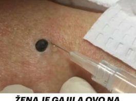 Zena je imala ovo na ledjima i kada je otisla dermatologu dozivjela je sok..